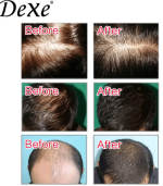 Dexe Anti-Hair Loss Lotion