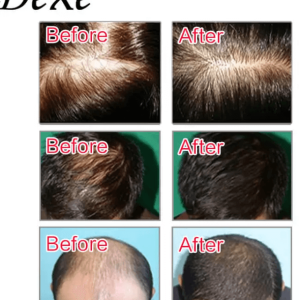 Dexe Anti-Hair Loss Lotion